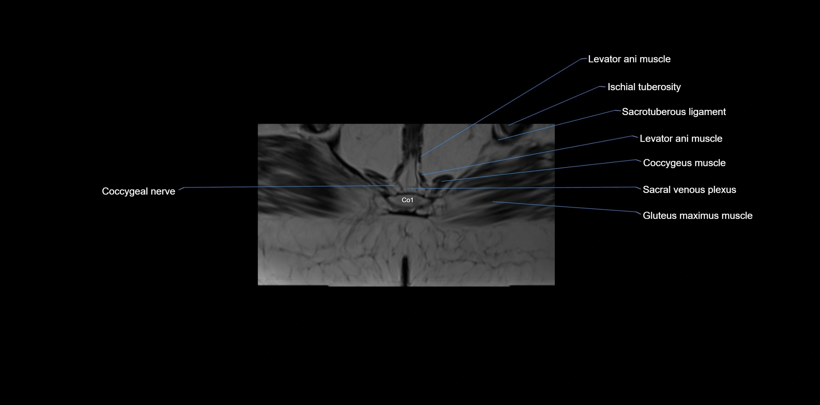 MRI sacrum, coccyx and sacroiliac joint axial cross sectional anatomy 3T  radiology  image-img-00001-00069.webp